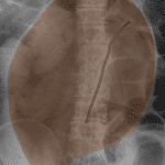 Coffee bean appearance of sigmoid volvulus.