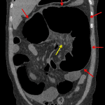 Cecal volvulus. Red arrows show marked dilation of the cecum in the left upper quadrant. Yellow arrow shows vascular engorgement and stranding in the cecal mesentery suggesting vascular compromise.