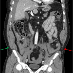 Traumatic herniation of the abdominal wall musculature from the left iliac crest (red arrow) compared to the normal appearance on the right (green arrow).