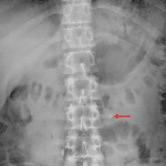Red arrow: ureteral calculus at the left ureteropelvic junction.