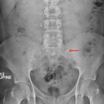 Followup radiograph obtained 2 weeks later shows the left ureteral calculus is now at the pelvic brim (red arrow).