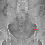 Followup radiograph obtained 4 weeks after the initial study now shows the ureteral calculus at the left ureterovesicular junction (red arrow).
