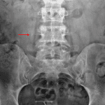 Red arrow: calcific density projecting below the right L4 transverse process concerning for a ureteral calculus.