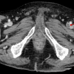 Red arrow: deep venous thrombosis involving the left femoral vein.