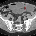 Small bowel obstruction with transition point in the mid jejunum (red arrow).