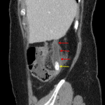 Acute appendicitis: dilated appendix with wall thickening and hyperenhancement (red arrows) and appendicoliths in the base of the appendix (yellow arrow).