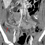 Distended, inflamed appendix with focal mural discontinuity midway along its length (red arrow).
