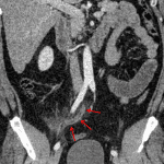 Mild appendiceal dilation and periappendiceal fat stranding (red arrows) consistent with acute suppurative appendicitis.