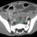 Appendiceal dilation near the tip with preserved mural enhancement on three sides (green arrows) but mural discontinuity anteriorly (red arrow) and a surrounding small fluid collection.