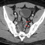 Red arrows: wall thickening and likely discontinuity along the right aspect of the distal sigmoid colon with adjacent hemorrhage, concerning for bowel injury/perforation.