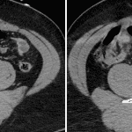 Red arrows: small area of active bleeding in the ileocolic mesentery which increases in size and decreases in density between arterial (left) and delayed (right) images.
