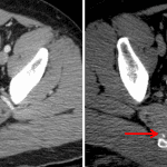 Red arrows: small area of active bleeding in the right piriformis muscle which decreases in density between arterial (left) and delayed (right) images.