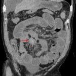 Partially calcified mass in the small bowel mesentery with surrounding desmoplastic reaction, which is a classic imaging appearance for carcinoid tumor.