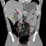 Cecal volvulus: distended, abnormally located cecum (outlined in red) with central (red arrow) and peripheral (yellow arrow) portal venous gas.