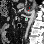 Celiac artery vasculitis: wall thickening of the celiac artery with surrounding fat stranding (red arrow) compared to the normal looking SMA (green arrow) on this sagittal reformat.