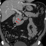 Red arrows: calcified stones in the common bile duct.