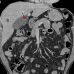 Acute cholecystitis with a stone in the cystic duct (red arrow).