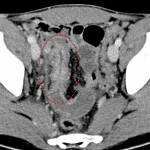 Crohn disease: terminal ileitis (circled in red).