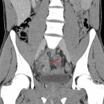 Red arrow: possible fistulous communication between the appendiceal tip and the terminal ileum.