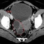 The right ovary containing multiple small cysts (circled in red) is seen separate from the mass (red arrow).
