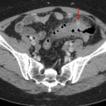 Acute diverticulitis with inflammatory changes centered about a ventrally directed proximal sigmoid diverticulum (red arrow).