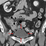 Circumferential bladder wall gas (red arrows) in this patient with emphysematous cystitis.