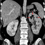 Areas of hypoattenuation in both kidneys concerning for pyelonephritis. Gas in the left renal collecting system (red arrows) concerning for emphysematous pyelitis.