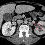 A dense, linear outline of the left renal pelvis and ureter indicates urothelial thickening and enhancement (red arrows).