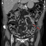 Circumscribed fat density structure with peripheral calcification adjacent to the proximal sigmoid colon consistent with acute epiploic appendagitis (red arrow).