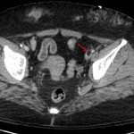 Fat embolism in the left external iliac vein (red arrow).