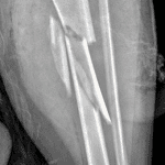 Left tibial and fibular fractures in this patient.