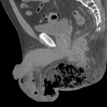 Fournier gangrene: extensive subcutaneous gas tracking from the scrotum to the perineum on this representative sagittal reformatted image.
