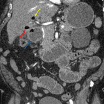 Gallstone ileus: inflamed gallbladder with intraluminal gas (red arrow) and poor separation from the adjacent dilated duodenum (blue arrow). Gas is also present in the extrahepatic biliary ducts (yellow arrow).