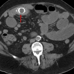 Gallstone ileus: proximal and mid small bowel dilation with peripherally calcified gallstones (red arrow) at the transition point in the ileum.