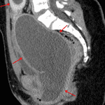 Markedly distended vagina and uterus (red arrows) consistent with hematometrocolpos in this patient with imperforate hymen.