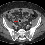 Red arrow: focal contained perforation associated with diverticulitis.