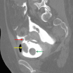 Intraperitoneal bladder rupture with a focal defect in the bladder dome (red arrow). There is residual blood clot in the bladder (yellow arrow) adjacent to the Foley balloon (green arrow).