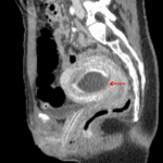 Red arrow: fluid-filled structure in the endometrial cavity in this patient with an early intrauterine pregnancy.