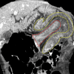 Intussusception: coronal reformat shows the intussusceptum (outlined in red) telescoping into the intussuscepiens (outlined in yellow). Between the two is the mesentery associated with the intussusceptum.