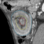 Intussusception: sagittal reformat shows the classic targetoid appearance with the intussusceptum in the center (outlined in red) surrounded by its mesentery (circled in yellow) surrounded by the intussuscepiens (circled in blue).