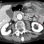 Mass at the distal margin of the intussusceptum (red arrows) concerning for neoplastic lead point.