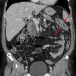 Short segment mural thickening centered about the splenic flexure of the colon (red arrows), which in this clinical context is concerning for ischemic colitis.