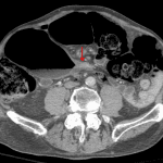 Large bowel obstruction with a possible transition point in the distal sigmoid colon (red arrow).
