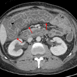 Lupus vasculitis: marked submucosal edema at the hepatic flexure and transverse colon resulting in a thumbprinting appearance of the mucosa (red arrows).