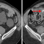 Right lower quadrant mesenteric hematoma with an area of active hemorrhage (red arrows) which increases in size between arterial (left) and delayed (right) images.