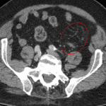 Subtle mesenteric contusion in the left lower quadrant (circled in red).