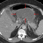 Necrotizing pancreatitis with an acute necrotic collection in the lesser sac (red arrows).