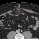 Omental infarct: fat stranding in the greater omentum (red arrows) subjacent to a small fat-containing right periumbilical hernia (yellow arrow).