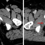 Red arrows: active hemorrhage adjacent to the right inferior pubic ramus fracture, with the area of contrast density increasing in size between arterial (left) and delayed (right) images.