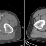 Small area of active bleeding adjacent to the right inferior pubic ramus fracture (red arrows) which increases in size between arterial (left) and delayed (right) phase images.
